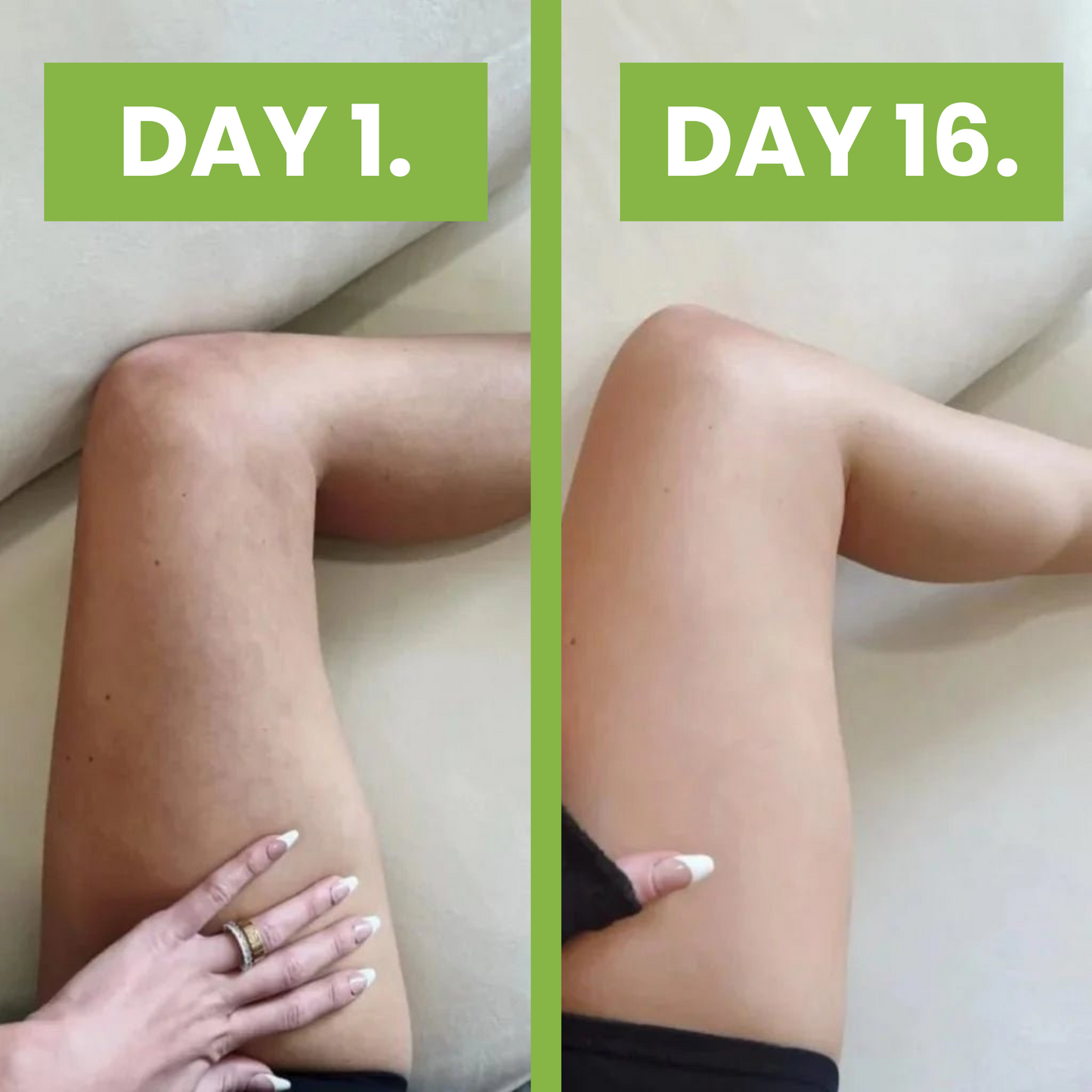 Lymphilite Cellulite Massage Roller